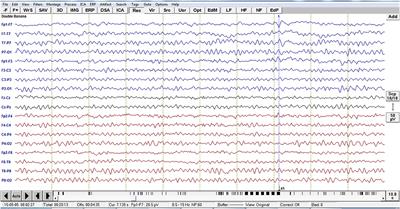 Analysis of Interictal Epileptiform Discharges in Mesial Temporal Lobe Epilepsy Using Quantitative EEG and Neuroimaging